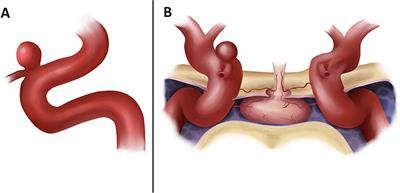 Optic Foraminotomy for Clipping of Superior Carotid-Ophthalmic Aneurysms